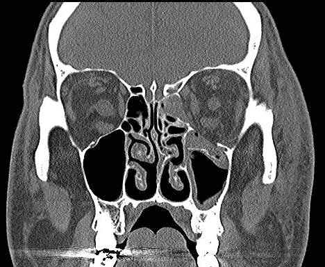 Figure 15. Computed tomography showing left orbital floor and medial wall fractures. Photo credit: Maj Brett Davies.