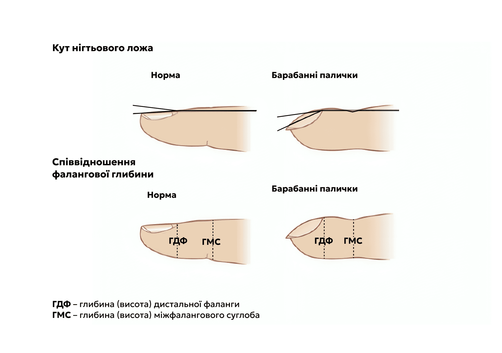 Figure_nail.png